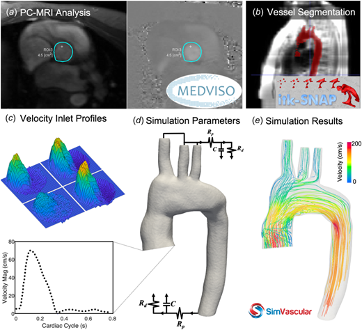 Study workflow diagram beginning with (a) PC-MRI analysis of the ascending thoracic aorta and (b)vessel segmentation, then (c) velocity inlet visualization and (d) estimating simulation parameters. Finally, (e) simulations were run and analyzed for all subjects (n = 6 for both groups). PC-MRI = phase-contrast magnetic resonance imaging; ROI = region of interest; Rp = proximal resistance; Rd = distal resistance; and C = compliance.