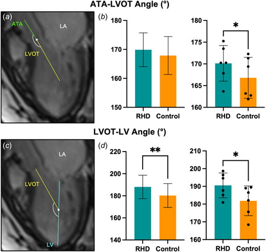 Panels (a) and (c) show representative sagittal (three-chamber view) cine images of the LV, left atrium, and ATA with overlaid ATA-LVOT and LVOT-LV angles, respectively. A significant difference in ATA-LVOT angles (b) was found in the age- and sex-matched subject cohort, while significant differences in (d) LVOT-LV angles were found in both the total subject analysis (RHD: n = 43, control: n = 28) and within the study cohort. *p<0.05, **p<0.01.